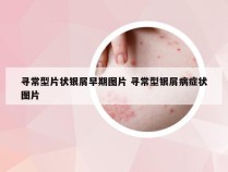 寻常型片状银屑早期图片 寻常型银屑病症状图片