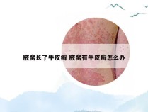 腋窝长了牛皮癣 腋窝有牛皮癣怎么办