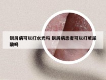 银屑病可以打水光吗 银屑病患者可以打玻尿酸吗