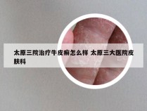 太原三院治疗牛皮癣怎么样 太原三大医院皮肤科
