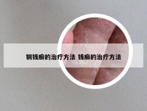 铜钱癣的治疗方法 钱癣的治疗方法