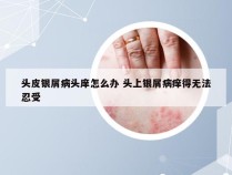 头皮银屑病头庠怎么办 头上银屑病痒得无法忍受
