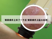 银屑病手上长了一个点 银屑病手上起小水泡