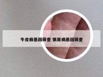 牛皮癣基因筛查 银屑病基因筛查