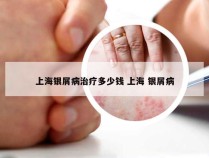 上海银屑病治疗多少钱 上海 银屑病