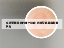 点滴型银屑病的几个阶段 点滴型银屑病恢复前兆
