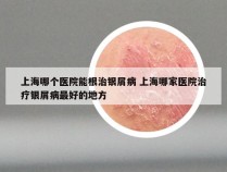 上海哪个医院能根治银屑病 上海哪家医院治疗银屑病最好的地方