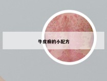 牛皮癣的小配方