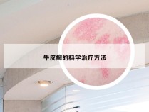 牛皮癣的科学治疗方法