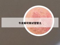 牛皮癣可做试管婴儿