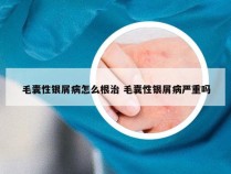 毛囊性银屑病怎么根治 毛囊性银屑病严重吗