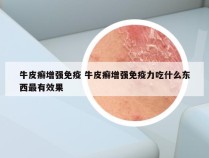牛皮癣增强免疫 牛皮癣增强免疫力吃什么东西最有效果