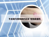 牛皮癣与铜钱癣的区别 铜钱癣痛吗