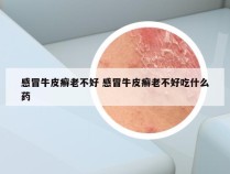 感冒牛皮癣老不好 感冒牛皮癣老不好吃什么药