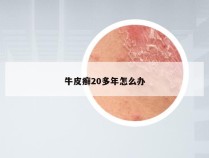 牛皮癣20多年怎么办