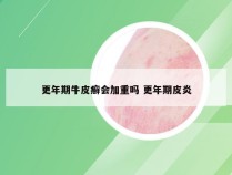 更年期牛皮癣会加重吗 更年期皮炎