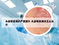 头部银屑病的严重图片 头部银屑病该怎么治疗