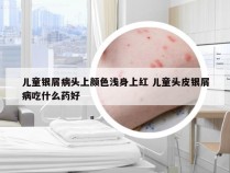 儿童银屑病头上颜色浅身上红 儿童头皮银屑病吃什么药好