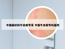 中国最好的牛皮癣专家 中国牛皮癣专科医院
