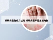 银屑病是免疫力过高 银屑病是不是免疫力低