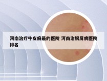河南治疗牛皮癣最的医院 河南治银屑病医院排名