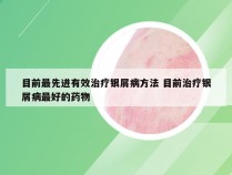 目前最先进有效治疗银屑病方法 目前治疗银屑病最好的药物