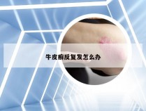 牛皮癣反复发怎么办