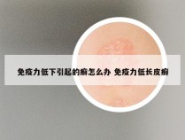 免疫力低下引起的癣怎么办 免疫力低长皮癣