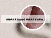 银屑病会出现痘痘吗 银屑病会不会长身上