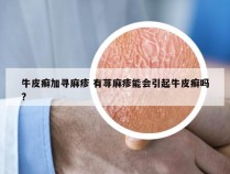 牛皮癣加寻麻疹 有荨麻疹能会引起牛皮癣吗?