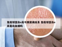 免疫球蛋白e高与银屑病关系 免疫球蛋白e高是白血病吗