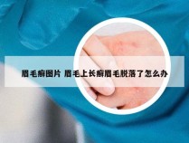 眉毛癣图片 眉毛上长癣眉毛脱落了怎么办