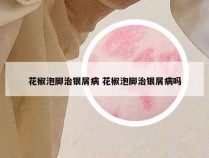 花椒泡脚治银屑病 花椒泡脚治银屑病吗