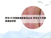 怀孕3个月银屑病厉害怎么办 怀孕几个月银屑病会好转