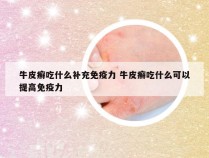 牛皮癣吃什么补充免疫力 牛皮癣吃什么可以提高免疫力