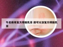 牛皮癣用复方樟脑乳膏 藓可以涂复方樟脑乳膏