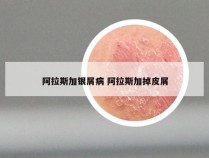 阿拉斯加银屑病 阿拉斯加掉皮屑