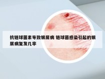 抗链球菌素导致银屑病 链球菌感染引起的银屑病复发几率