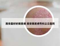 西安最好的银屑病 西安银屑病专科公立医院
