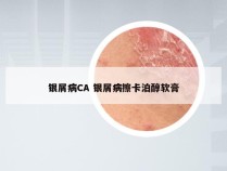 银屑病CA 银屑病擦卡泊醇软膏