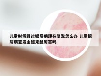 儿童时候得过银屑病现在复发怎么办 儿童银屑病复发会越来越厉害吗