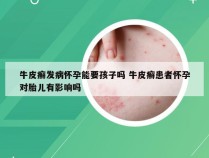 牛皮癣发病怀孕能要孩子吗 牛皮癣患者怀孕对胎儿有影响吗