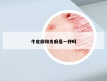 牛皮癣和皮癣是一种吗