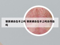 银屑病会在手上吗 银屑病会在手上吗会传染吗