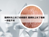胳膊肘尖上长了皮癣图片 胳膊肘上长了像癣一样起干皮