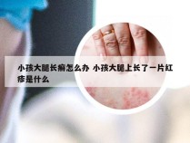 小孩大腿长癣怎么办 小孩大腿上长了一片红疹是什么