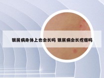 银屑病身体上也会长吗 银屑病会长疙瘩吗