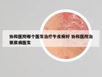 协和医院哪个医生治疗牛皮癣好 协和医院治银屑病医生