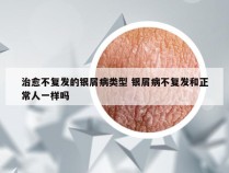 治愈不复发的银屑病类型 银屑病不复发和正常人一样吗