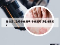 维生素C治疗牛皮癣吗 牛皮廨可以吃维生素c
